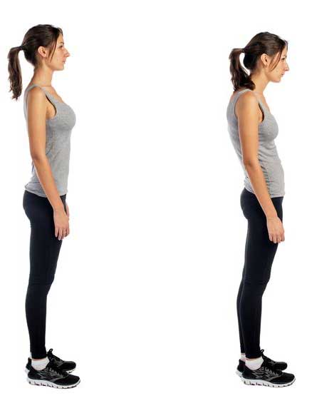 lordosis-or-swayback